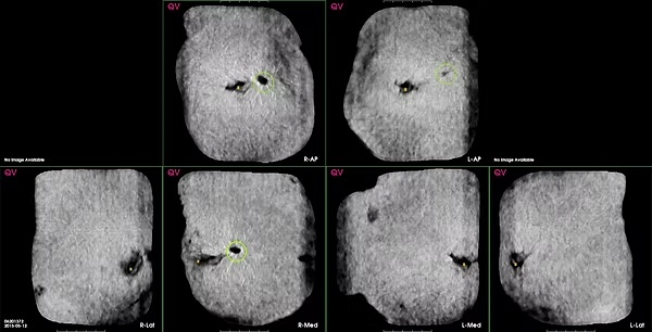 QVCAD display highlighting suspicious findings across bilateral automated breast ultrasound views
